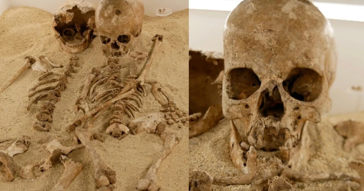 12 Bin Yıl Önce İtalya’da Nadir Genetik Hastalık İzleri