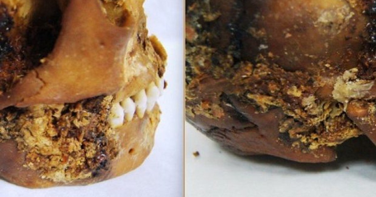 A Successful Jaw Prosthesis from 2,500 Years Ago: Surprising Evidence of Scythian Medicine
