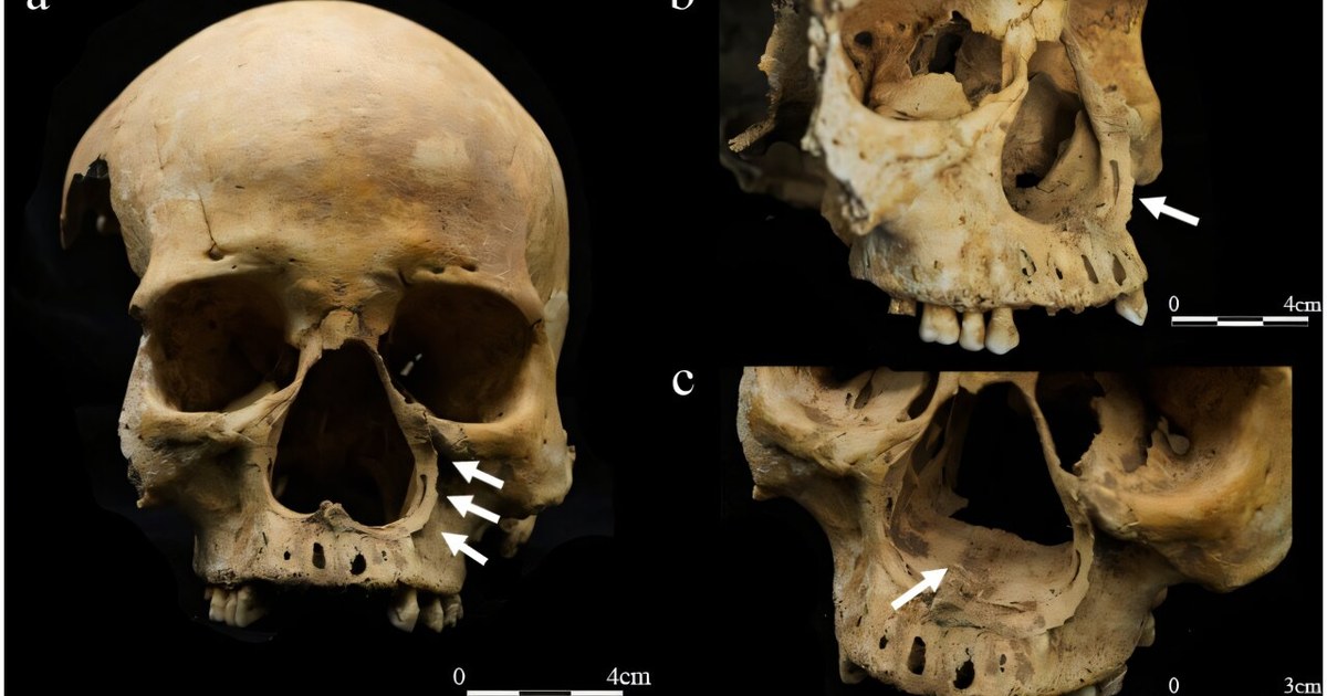 Chine : Un squelette vieux de 700 ans révèle la première preuve physique de la mutilation nasale comme châtiment